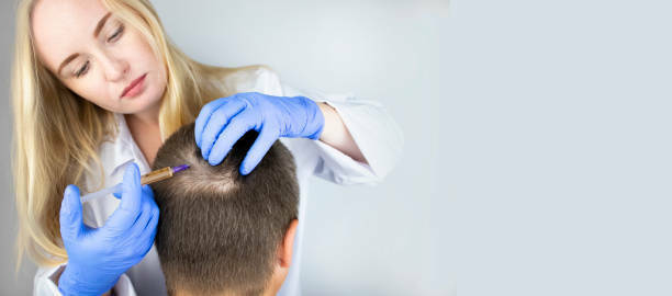 Best Alopecia Areata Treatments for Hair loss