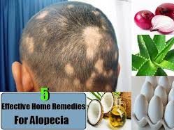 Best Alopecia Areata Treatments for Hair loss | Natural treatment