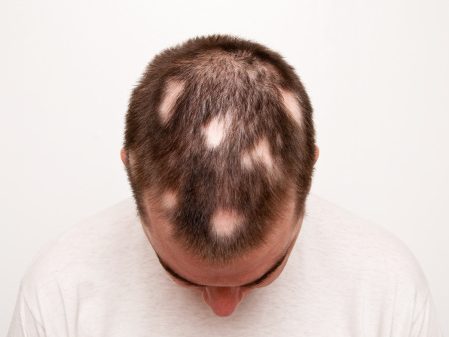 Best Alopecia Areata Treatments for Hair loss